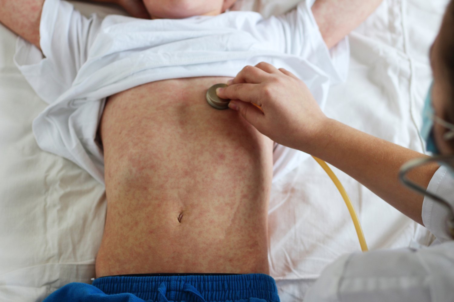 Kızamık, Kızamık Aşısı, Avrupa, Orta Asya, Dünya Sağlık Örgütü, UNICEF, Salgın, Aşılama Oranları, Herd Bağışıklığı, MMR Aşısı, Sağlık Güvenliği, Aşı Programları, Bulaşıcı Hastalıklar, Aşı Karşıtlığı, Teksas, New Mexico, Oklahoma, Mennonitler, Aşılanmamış Topluluklar

