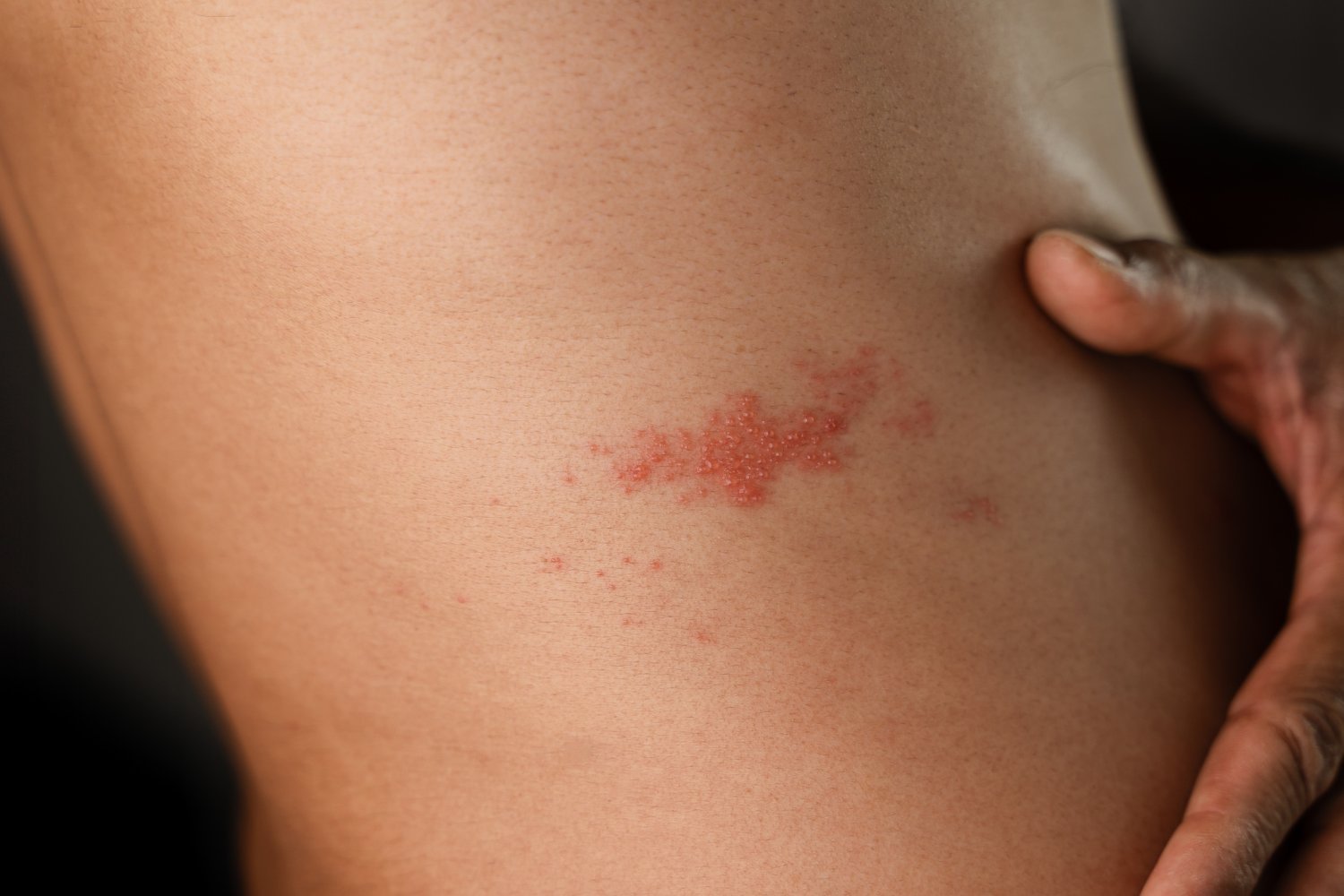 shingles aşısı, zona aşısı, kalp krizi, inme, kardiyovasküler hastalık, zoster aşısı, Zostavax, Shingrix, Güney Kore, sağlık araştırması, bağışıklık sistemi, varicella zoster virüsü, alzheimer, demans, sinir ağrısı, kardiyovasküler risk, halk sağlığı
