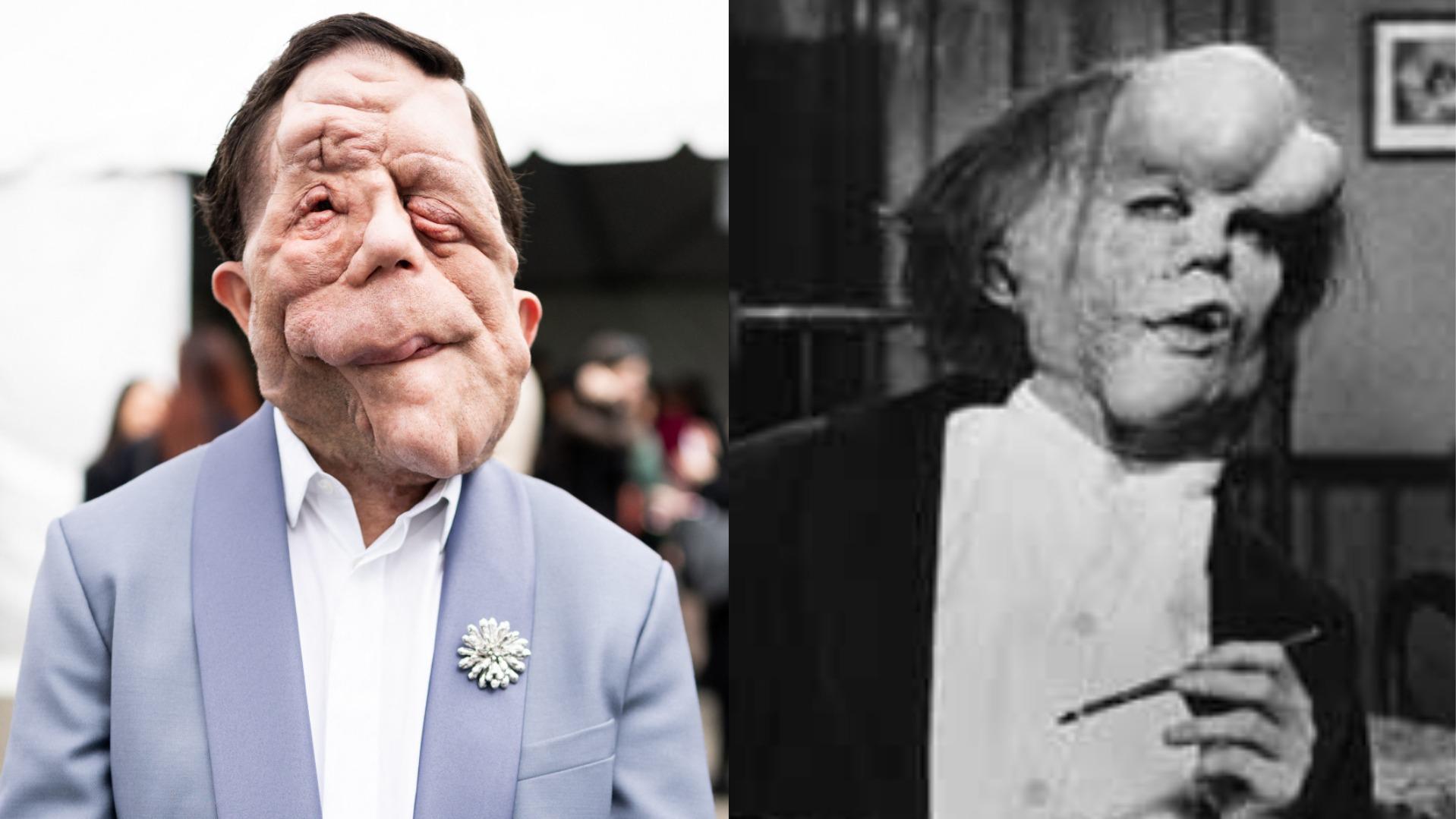 Adam Pearson, Elephant Man, Joseph Merrick, neurofibromatose, engellilik, film, tiyatro, Bernard Pomerance, Jack Huston, uyarlama, Sebastian Stan, A Different Man, Adam Schimberg, John Hurt, David Lynch, Frederick Treves, Oscars, Eve Pomerance, engelli hakları, sinema, biyografi, 1977, 1980, Hollywood Reporter
