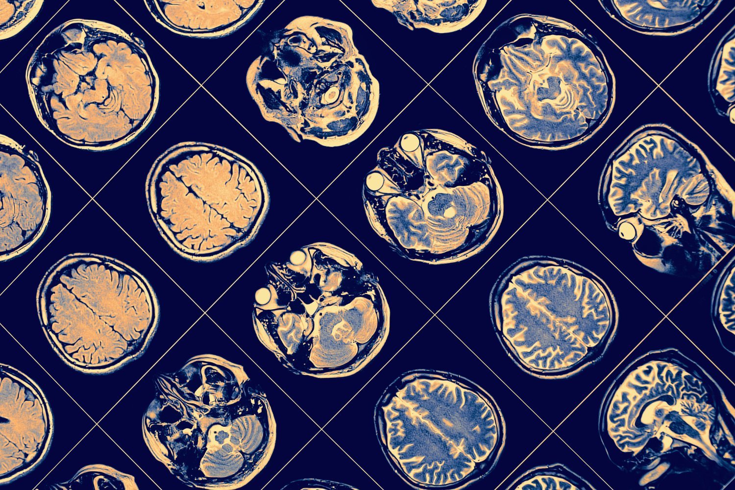 Kanada, New Brunswick, gizemli beyin hastalığı, nörolojik sendrom, bilinmeyen neden, NSUC, küme, salgın, Alier Marrero, araştırma, JAMA Neurology, tanı, semptomlar, demans, hafıza kaybı, halüsinasyon, nörolog, halk sağlığı, çevre, toksin, MIND Kliniği, adli tıp, otopsi, Alzheimer, Parkinson, travmatik beyin hasarı, EEG, hatalı teşhis, Yves Léger, soruşturma, Yeni Brunswick Hükümeti, tıbbi rapor, sağlık ağı
