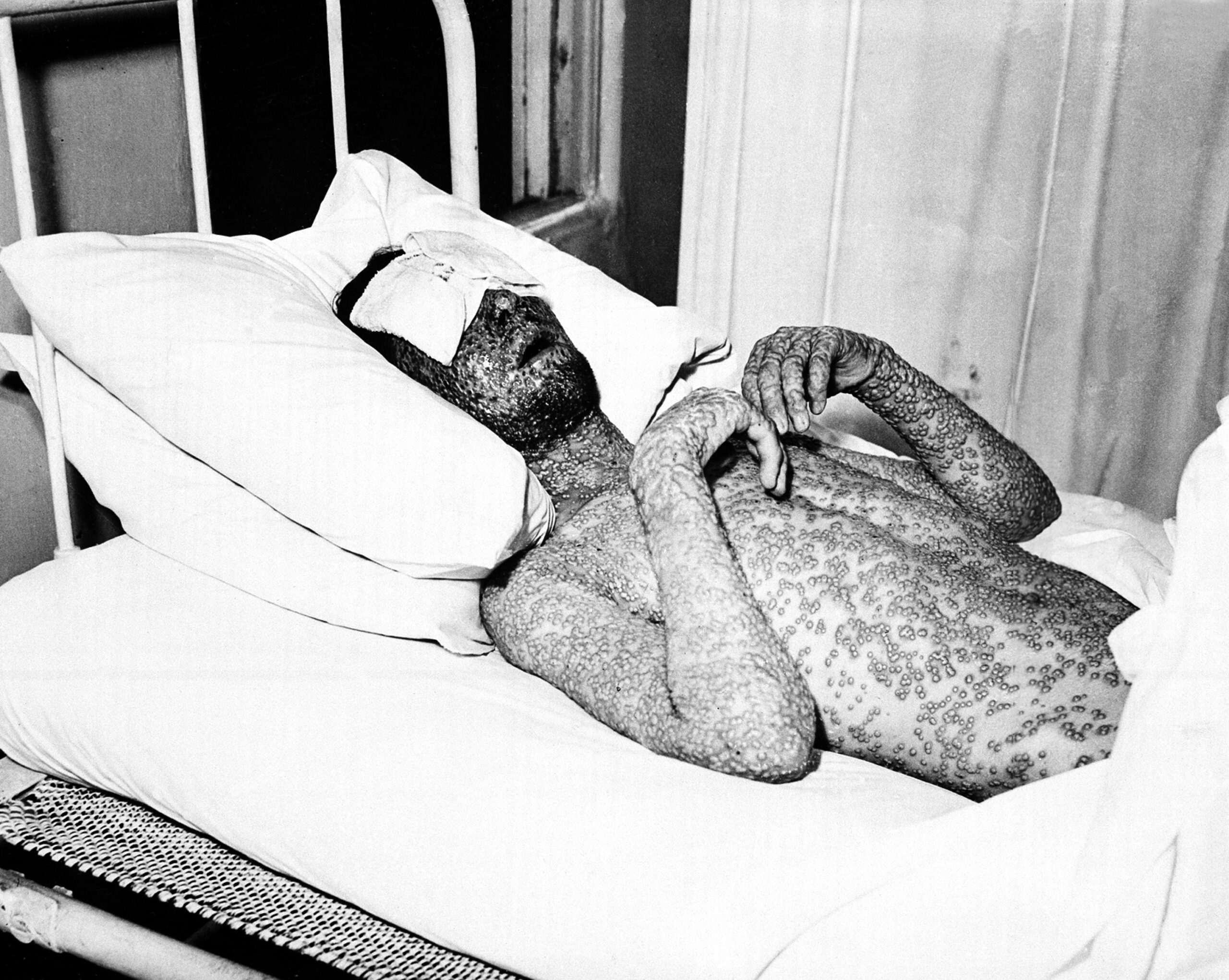 Covid-19, küçük çiçek, bulaşıcı hastalıklar, salgın, aşılama, küresel sağlık, halk sağlığı, Dünya Sağlık Örgütü, eradikasyon, epidemiyoloji, bulaşma, ölüm oranı, sağlık sistemi, uluslararası işbirliği, pandemik hazırlık, DSÖ, CDC, biyogüvenlik
