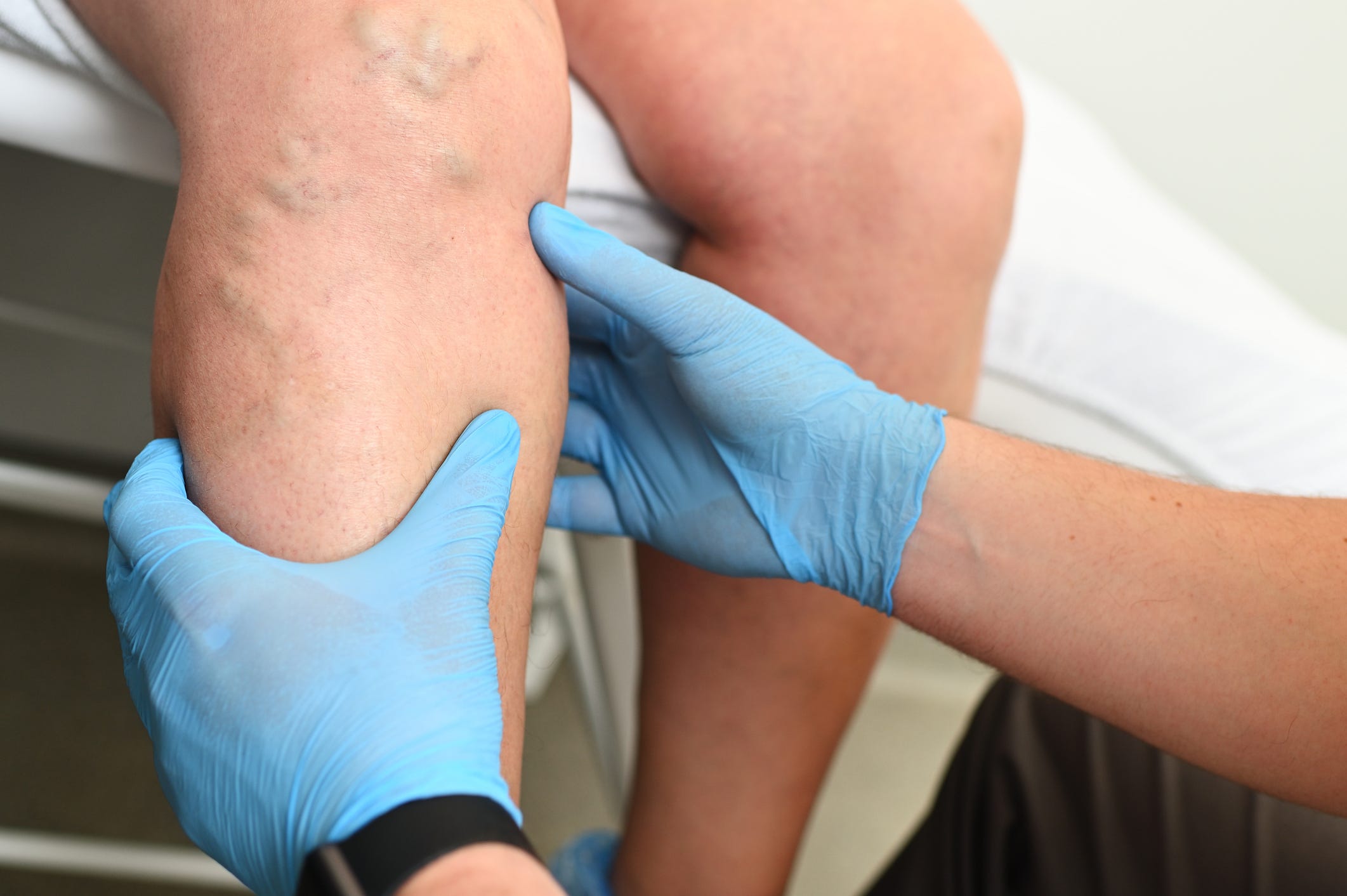 kan pıhtısı, tromboz, emboli, derin ven trombozu (DVT), pulmoner emboli, beyin embolisi, koroner emboli, arteriyel emboli, pıhtılaşma, kan damarları, trombositler, fibrin, kardiyolog, damar hastalıkları uzmanı, hematoloji, kan pıhtılaşması nedenleri, kan pıhtılaşması risk faktörleri, sigara, hamilelik, obezite, yaşlanma, ameliyat, genetik yatkınlık, hormonal tedavi, otoimmün hastalıklar, antifosfolipid sendromu, kan basıncı, felç, kalp krizi, böbrek yetmezliği, mezenter iskemisi, kan pıhtılaşması önleme, Ulusal Kan Pıhtısı İttifakı
